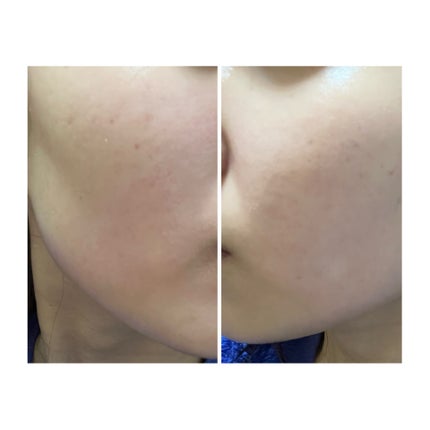 ぽむ on LIPS 「2023.9.13皮膚科に受診 エピデュオとヘパリン処方1枚目..」(4枚目)