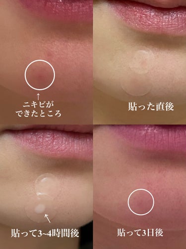 G9SKIN AC SOLUTION CLEAR SPOT PATCHのクチコミ「おすすめのニキビパッチを紹介します！

G9SKINのニキビパッチです✨
(AC SOLUTI.....」（3枚目）