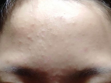 ペアアクネクリームW(医薬品)/ペア/その他を使ったクチコミ(1枚目)