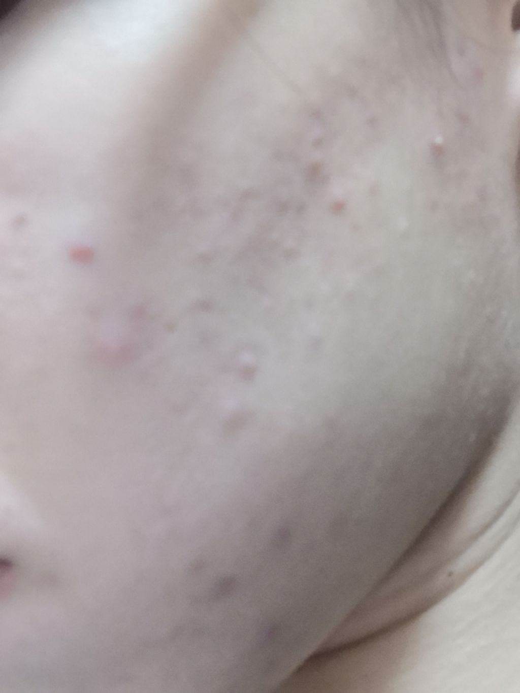 バイオイル/バイオイル/フェイスオイルを使ったクチコミ（1枚目）