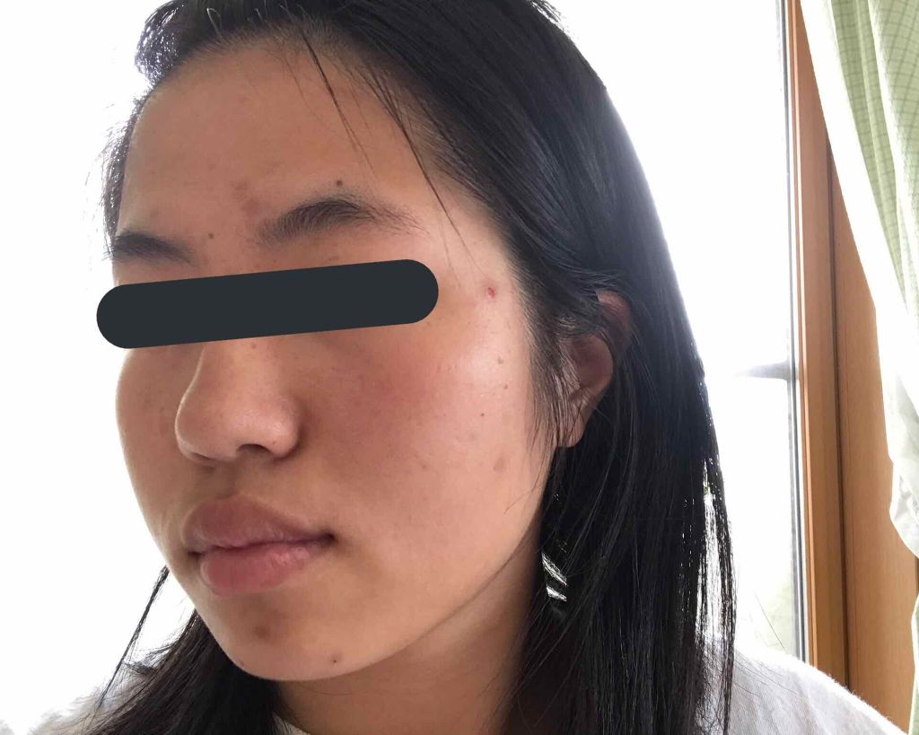 薬用 しみ 集中対策 美容液/メラノCC/美容液を使ったクチコミ（3枚目）
