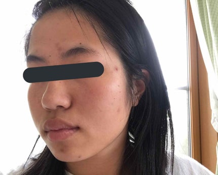 薬用 しみ 集中対策 美容液/メラノCC/美容液を使ったクチコミ(3枚目)