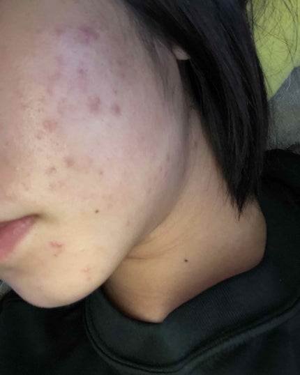 香織 on LIPS 「助けてください…高校3年生の香織(カオリ)です🌱𓂃𓈒𓏸オイリー..」(2枚目)