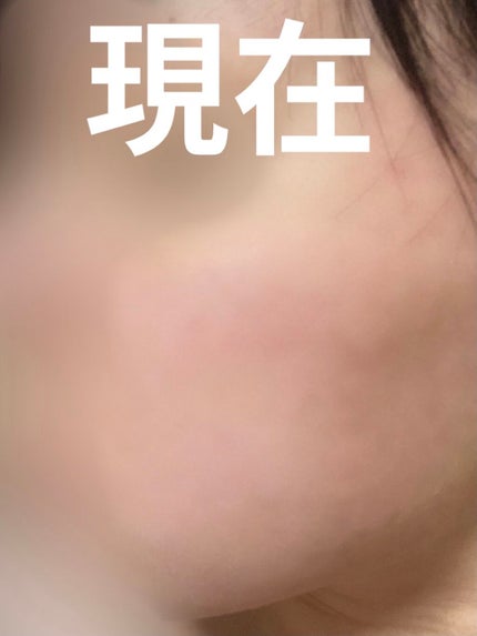 プレミア敏感肌用 Lディスポ/シック/シェーバーを使ったクチコミ(3枚目)