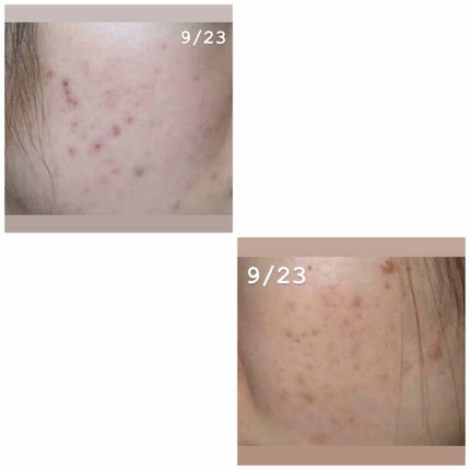 薬用 しみ 集中対策 美容液/メラノCC/美容液を使ったクチコミ(1枚目)