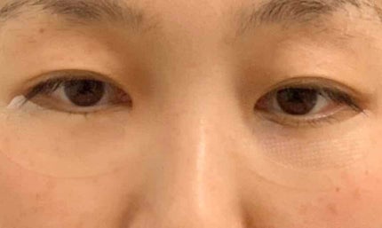 メラノアタック集中プログラム/sirobari/スキンケアキットを使ったクチコミ(4枚目)