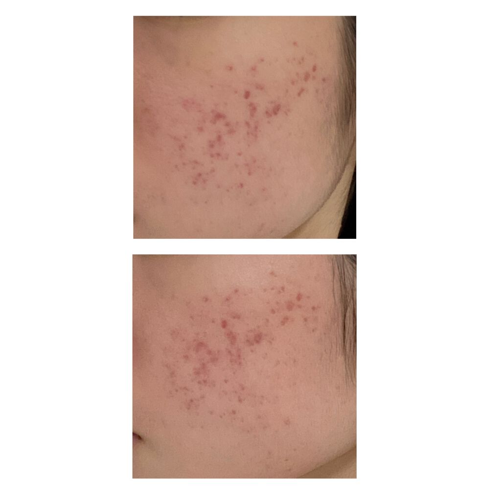 ベピオゲル/マルホ株式会社/その他を使ったクチコミ（3枚目）