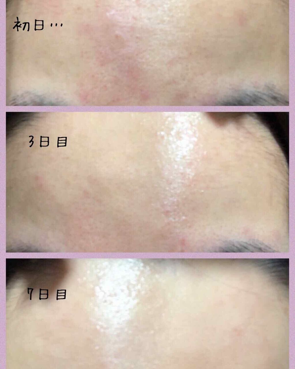 薬用 しみ 集中対策 美容液/メラノCC/美容液を使ったクチコミ(2枚目)