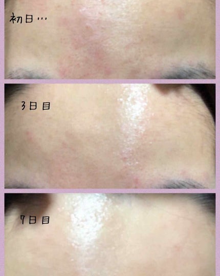 薬用 しみ 集中対策 美容液/メラノCC/美容液を使ったクチコミ(2枚目)