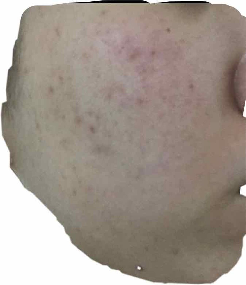 ベピオゲル/マルホ株式会社/その他を使ったクチコミ（2枚目）