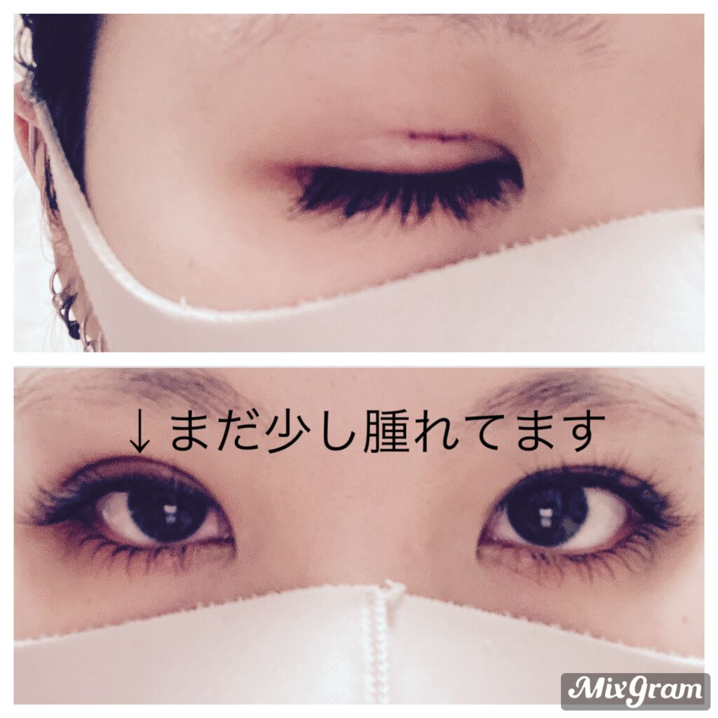 青くん on LIPS 「2日目の夜です!腫れは思ったより引いたのか慣れたのかわかりませ..」(2枚目)