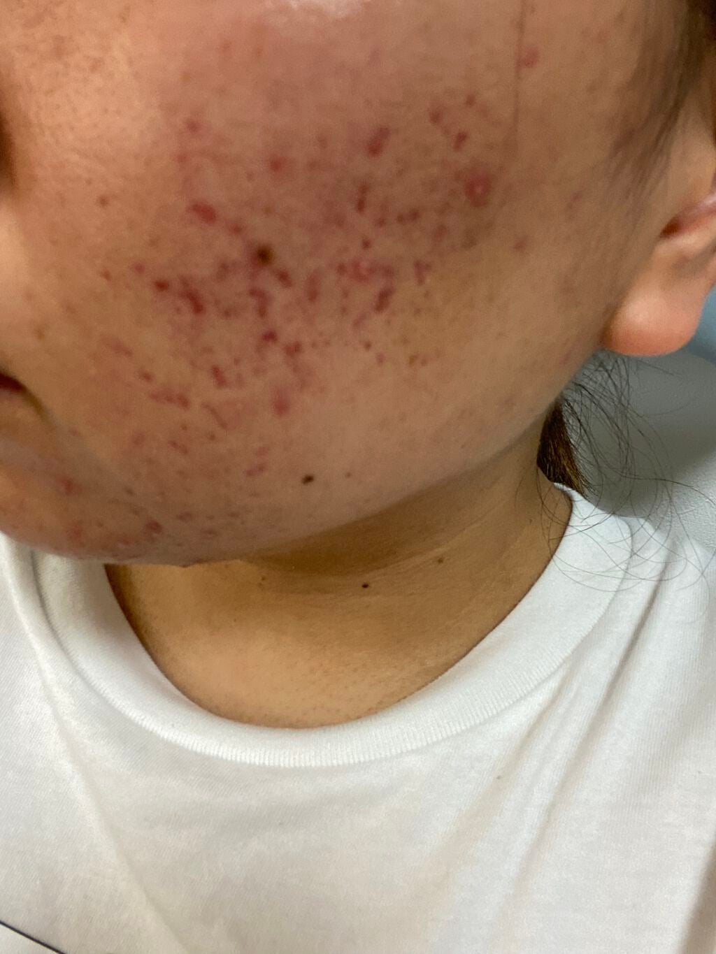 もち on LIPS 「こんばんは!約1週間ぶりです全くニキビが良くなりません。もうす..」(3枚目)