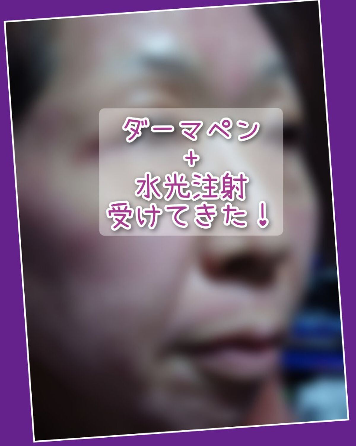 瞳子うさぎ@定期的に投稿ある方フォロバ on LIPS 「今まで埋没二重術や、糸リフトなど美容医療を経験してきましたが、..」(1枚目)