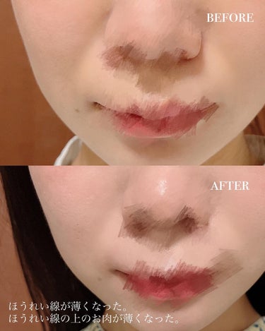 ぴーちゃん🧡 on LIPS 「医療ハイフレポ👩‍⚕️今日はコスメではなく美容医療ハイフについ..」（2枚目）