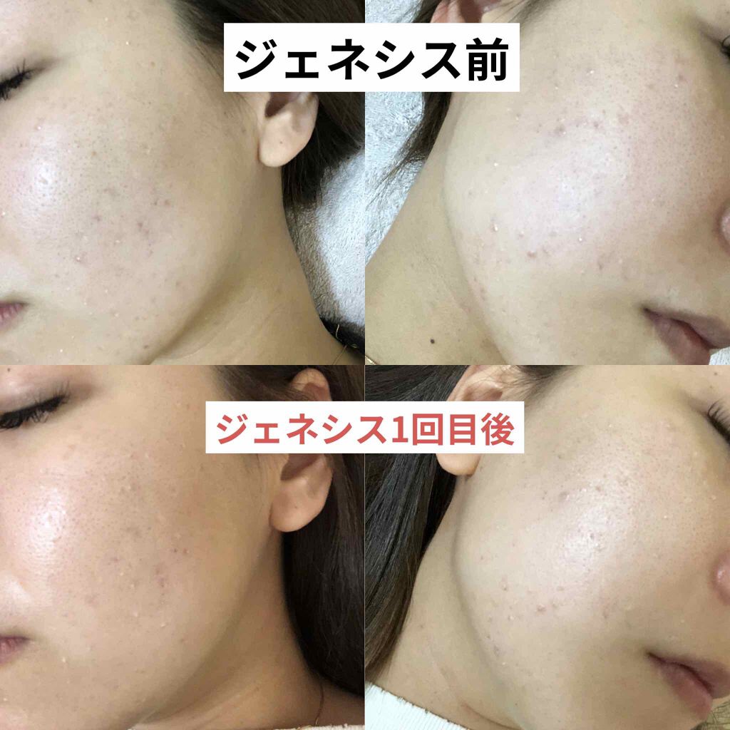 ニョッキ on LIPS 「洗顔、保湿クリーム、ニキビ薬は皮膚科から処方されたものを使って..」(2枚目)