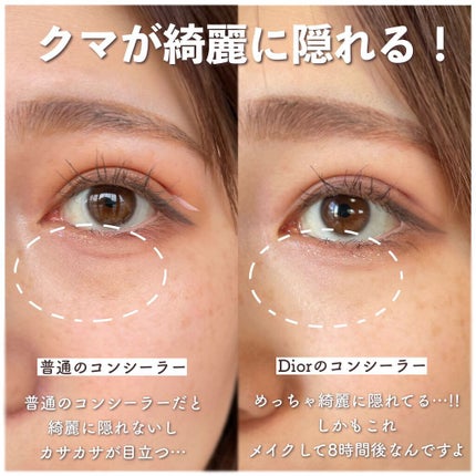 【旧】ディオールスキン フォーエヴァー スキン コレクト コンシーラー/Dior/リキッドコンシーラーを使ったクチコミ(5枚目)