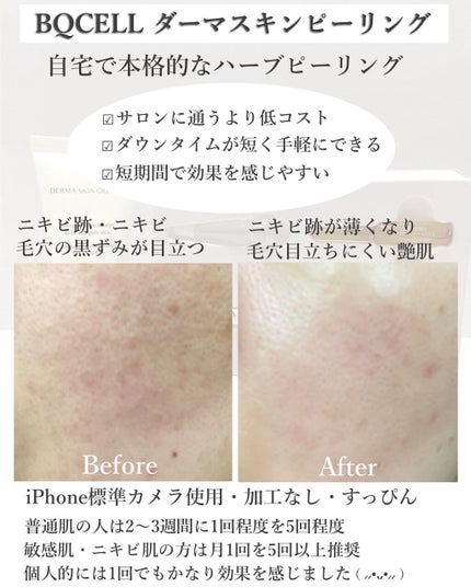 ダーマスキンピーリング/BQCELL/その他キットセットを使ったクチコミ(6枚目)