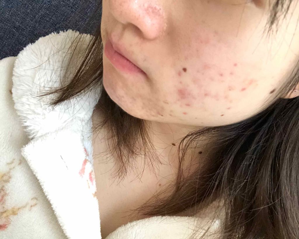 マンスリースキンケアプログラム(旧)/APEX/スキンケアキットを使ったクチコミ(3枚目)