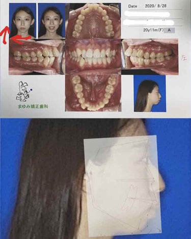 マウスピース矯正/その他を使ったクチコミ（3枚目）