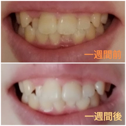 デンタルホワイトニング/プロポリンス/マウスウォッシュ・スプレーを使ったクチコミ(2枚目)