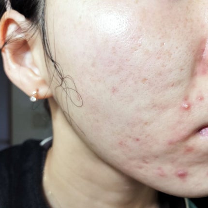 ラッシュ 抱擁の満月のクチコミ「✍11/30
の#汚肌工事録
\きょうもありがとう💝お仕事の人は、おつかれさま☕/
3日間.....」(1枚目)