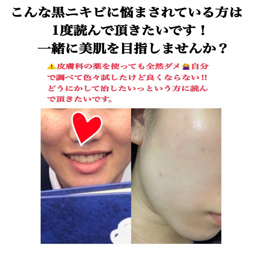 ビーソフテン ローション(医薬品)/持田製薬/その他を使ったクチコミ（1枚目）