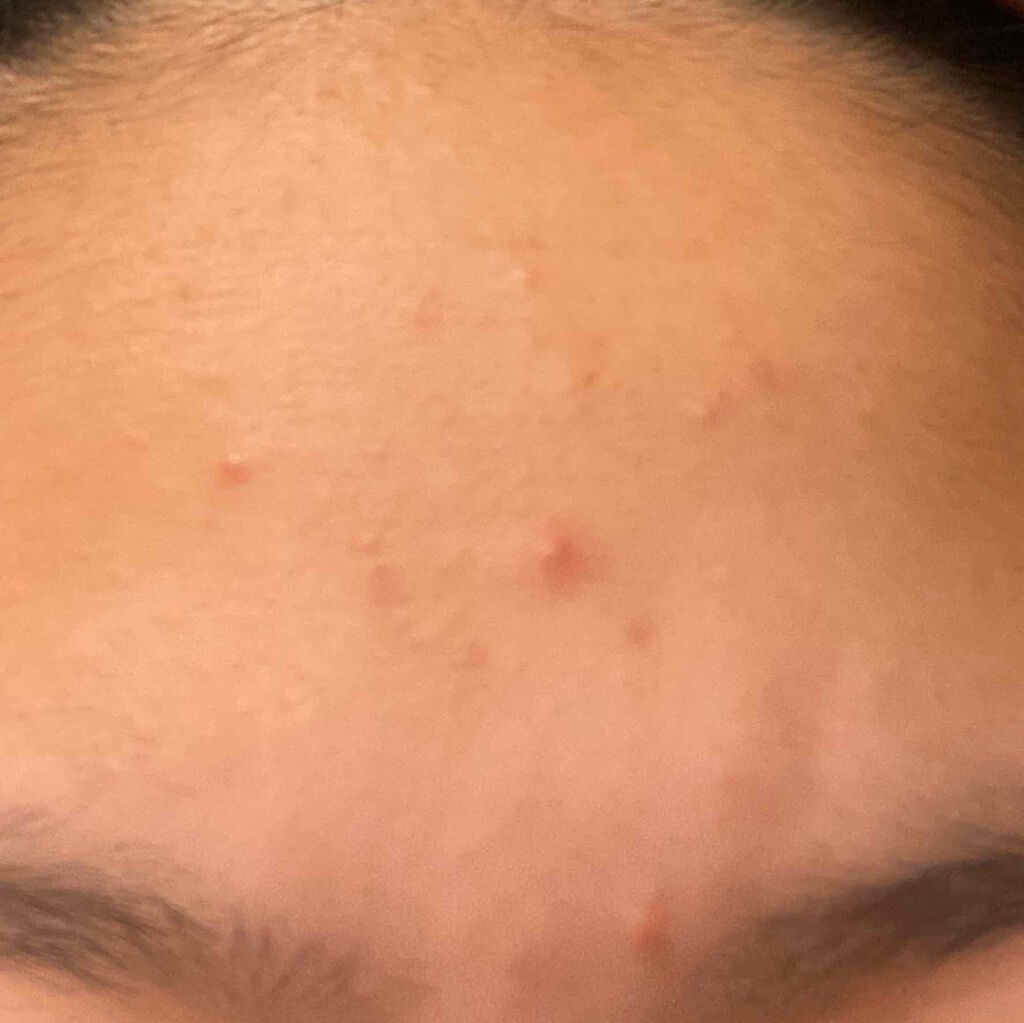 オロナインＨ軟膏 (医薬品)/オロナイン/その他を使ったクチコミ（2枚目）