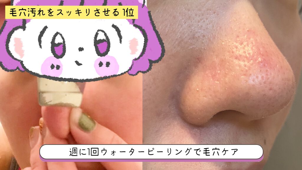 アクリアルピーリングプロEX/COSBEAUTY/美顔器・マッサージを使ったクチコミ（2枚目）