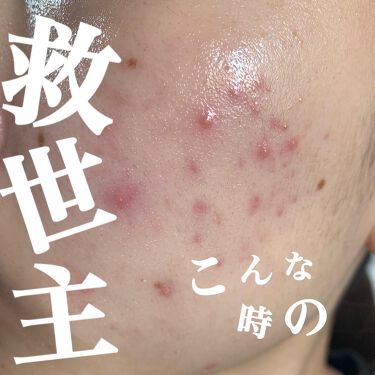 テラ コートリル 軟膏 医薬品 ジョンソン エンド ジョンソンの使い方を徹底解説 1日で効果あるニキビ対策 薬用品なの By Kuro 混合肌 代前半 Lips