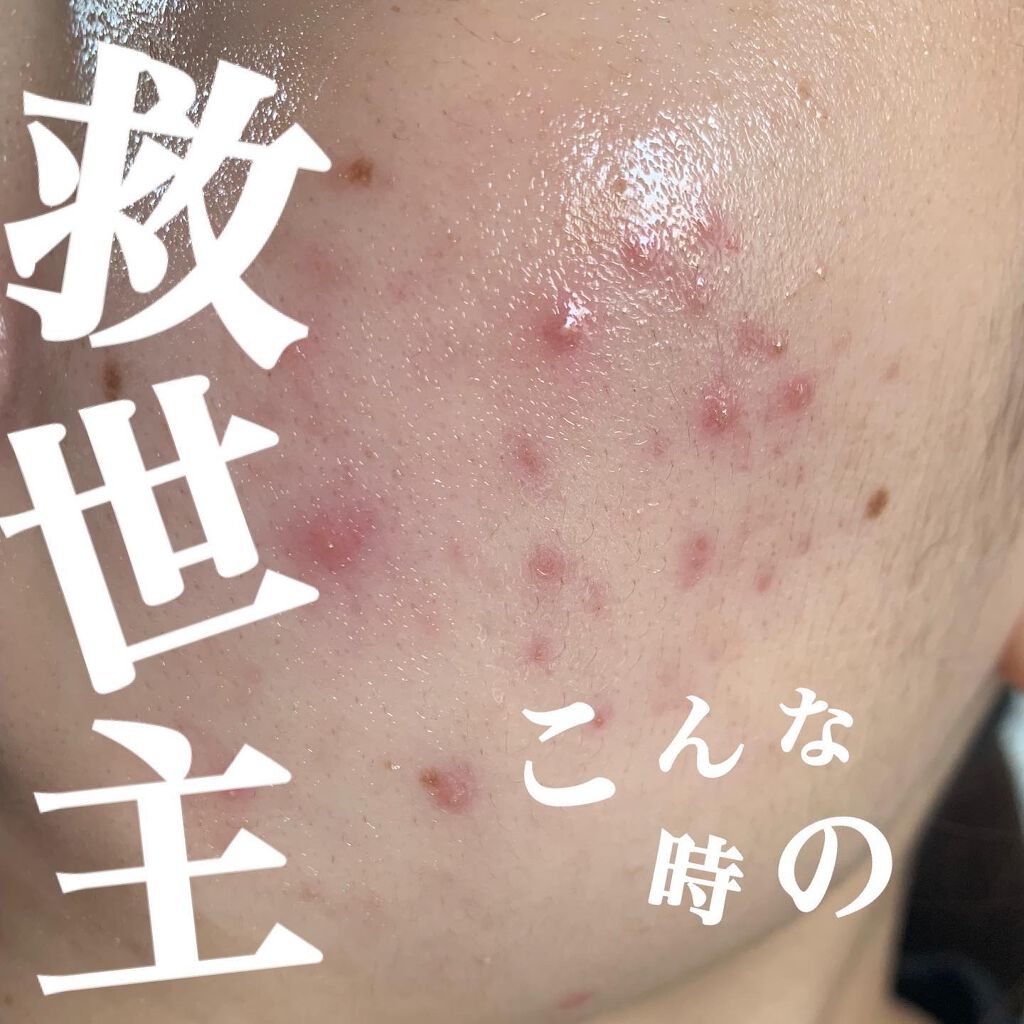 テラ コートリル 軟膏 医薬品 ジョンソン エンド ジョンソンの使い方を徹底解説 1日で効果あるニキビ対策 薬用品なの By Kuro 混合肌 代前半 Lips