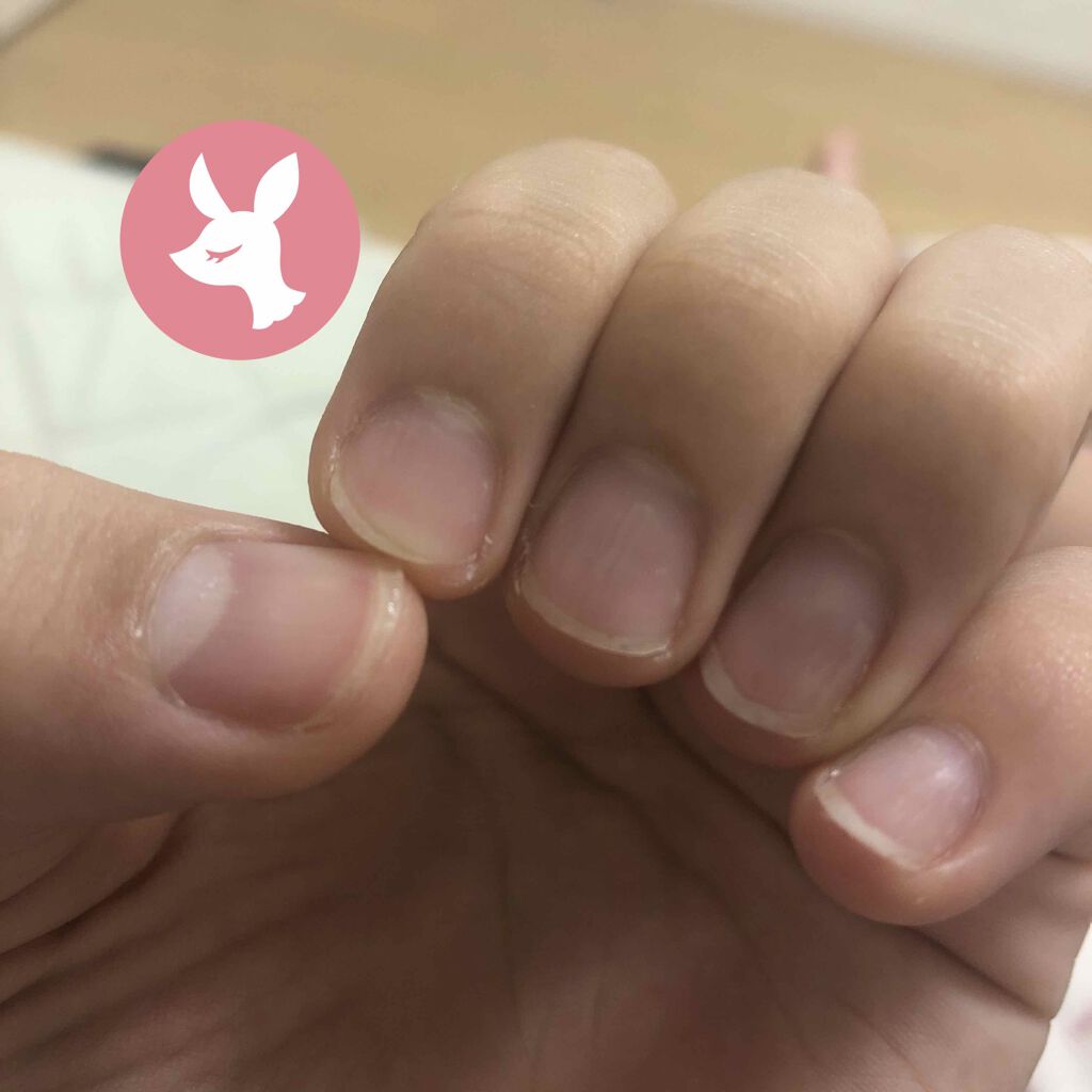 さくら on LIPS 「噛む癖を直す方法私は小さい時から爪を噛む癖がありました。イライ..」(1枚目)