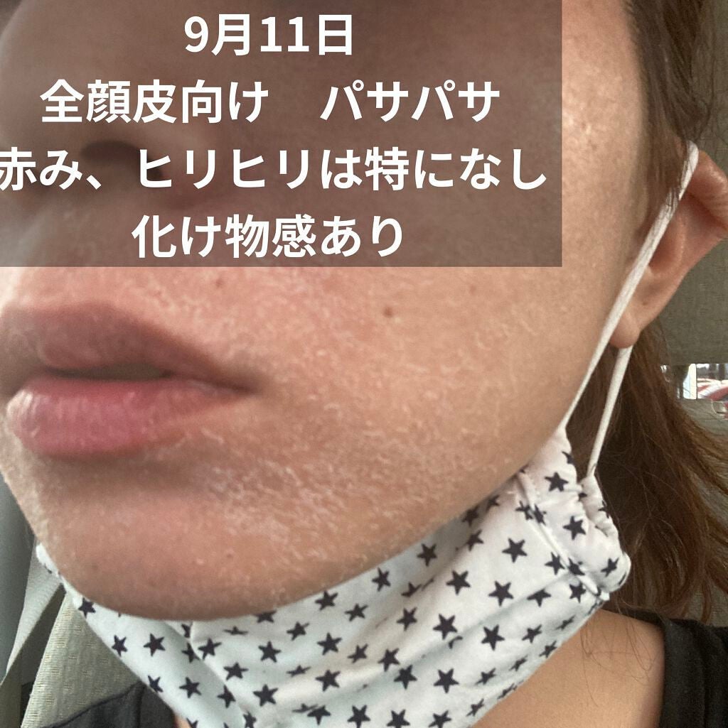 たゆあれ34412 on LIPS 「9月11日セラピューティック4日目全顔皮向けピリピリとかは特に..」(2枚目)