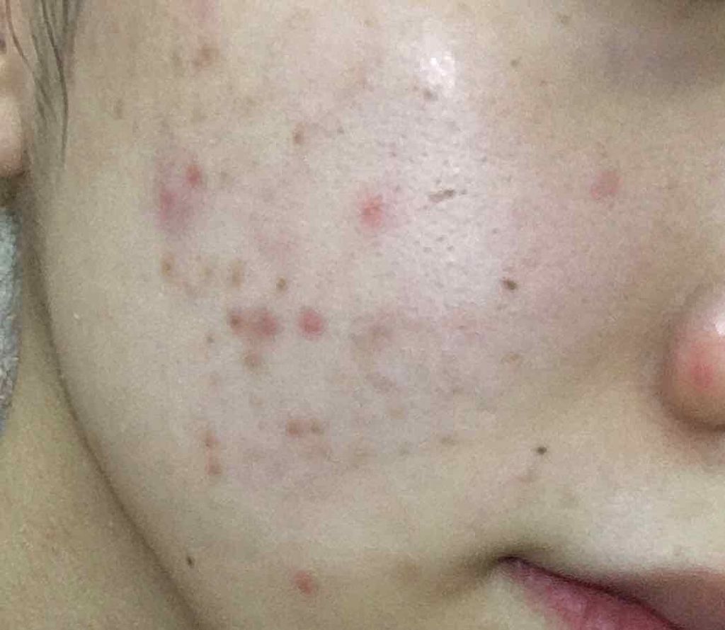 薬用 しみ 集中対策 美容液/メラノCC/美容液を使ったクチコミ(2枚目)