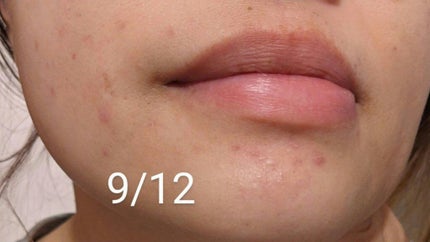 チョコラBBプラス (医薬品)/チョコラBB/その他を使ったクチコミ(5枚目)