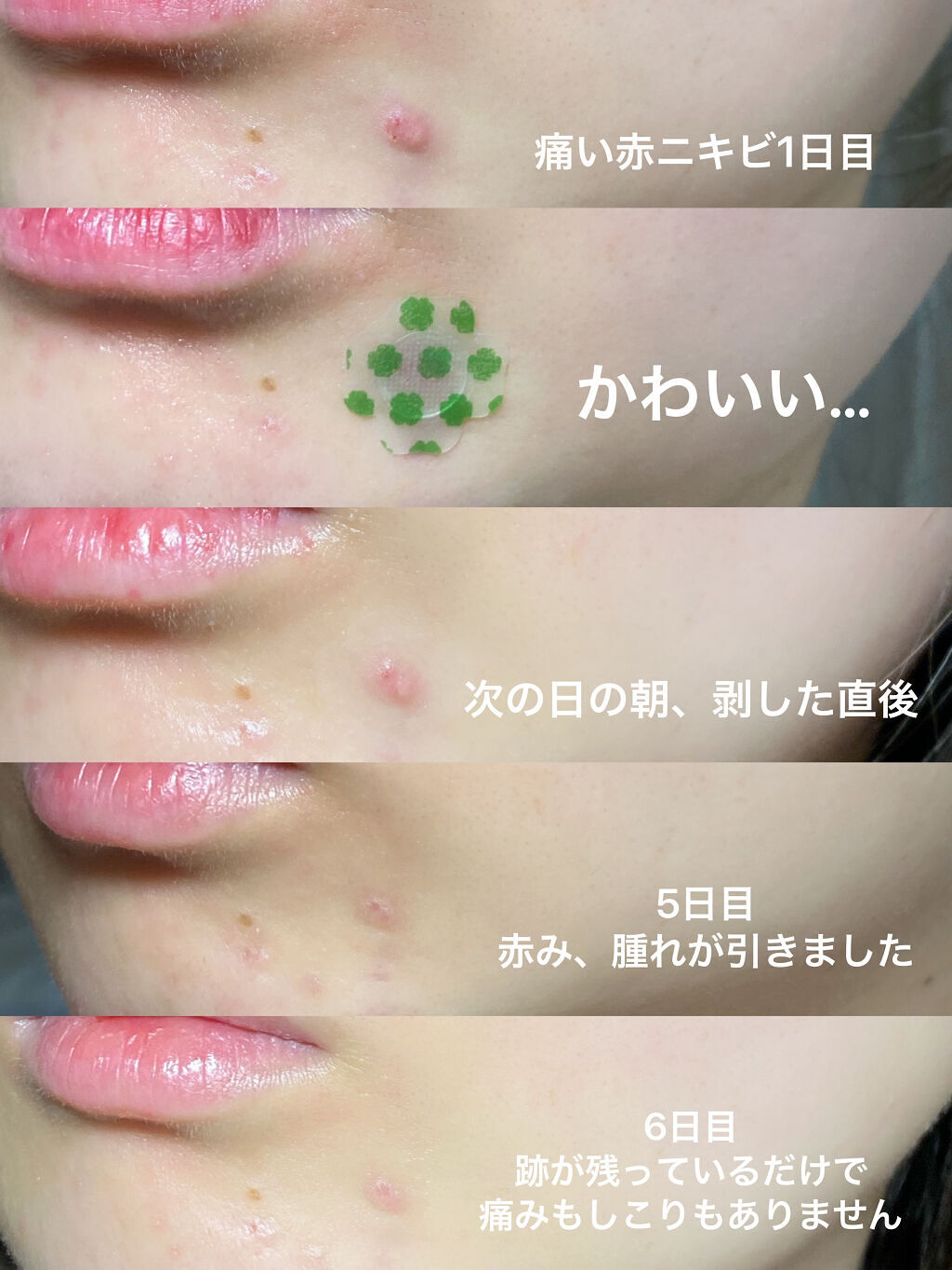 レチノール　シカ　フォーカシングパッチ/innisfree/にきびパッチを使ったクチコミ（2枚目）