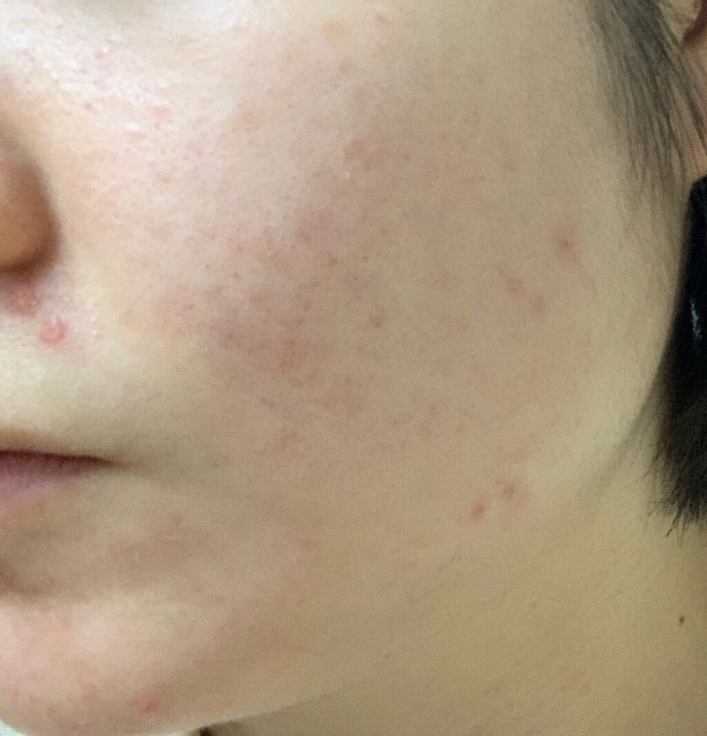 アクネキュアクリーム(医薬品)/IHADA/その他を使ったクチコミ（3枚目）