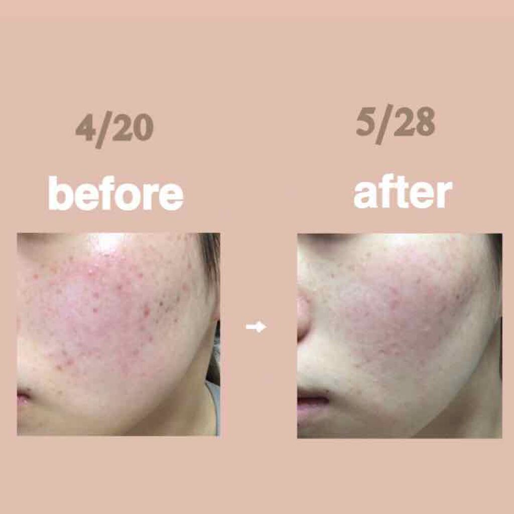 ノブ Ａ アクネソープ/NOV/洗顔石鹸を使ったクチコミ（2枚目）