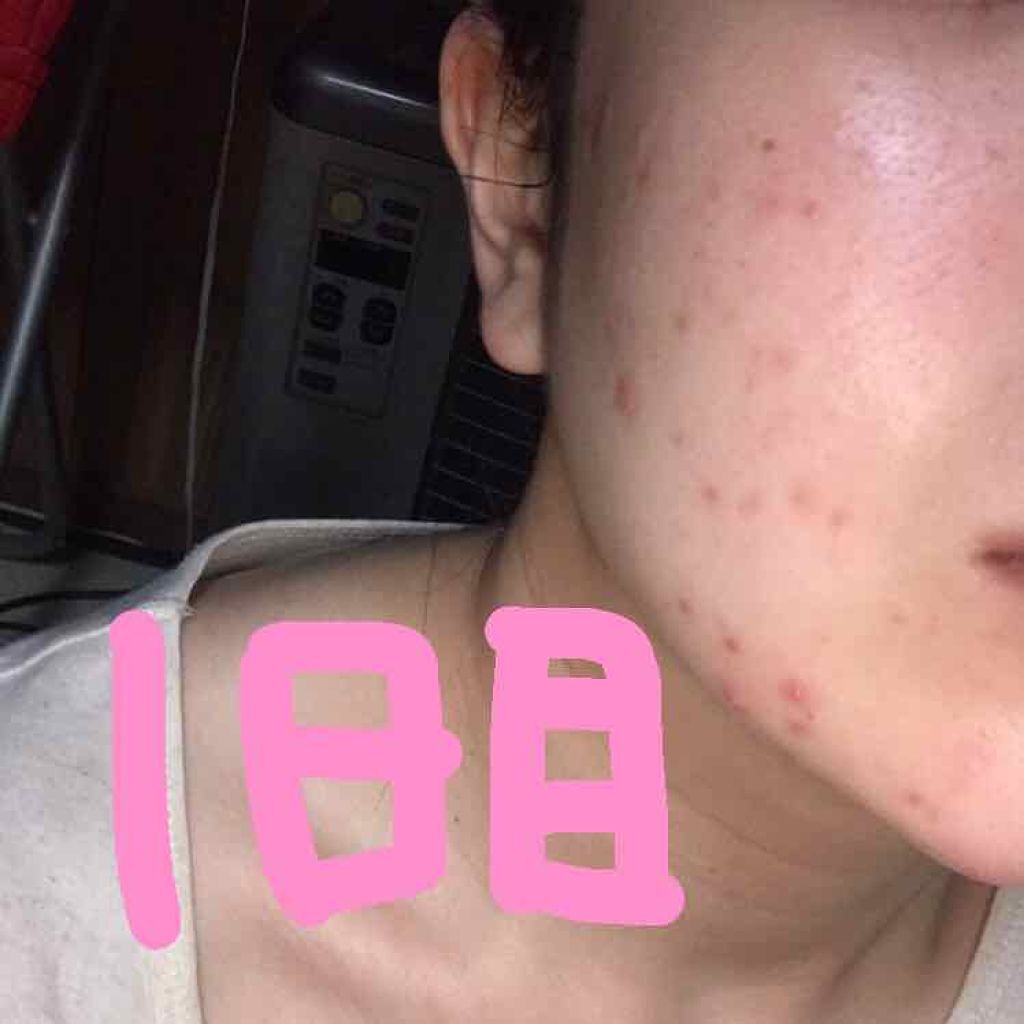 Rie❁❁ on LIPS 「2枚目ニキビの汚い画像あります*閲覧注意⚠です*ニキビの観察日..」(3枚目)