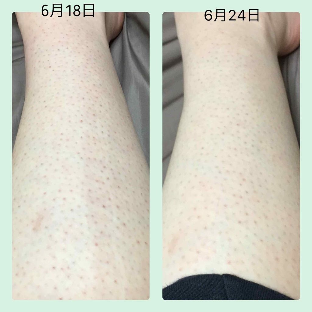 ケアノキュア（医薬品）/小林製薬/その他を使ったクチコミ（2枚目）