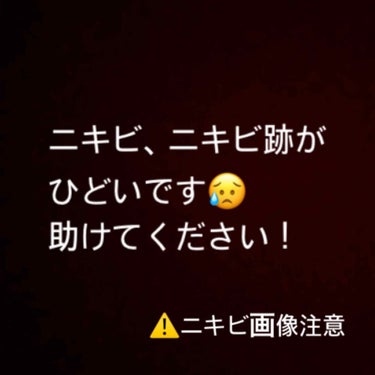 こんにちは…！！
少し前落ち着いてたはずのニキビがまたできて、ニキビ跡まで…！！！😭
よろしければみなさんがニキビを治すことができた、ニキビ跡をきれいにすることができた方法を教えていただきたいです！(欲