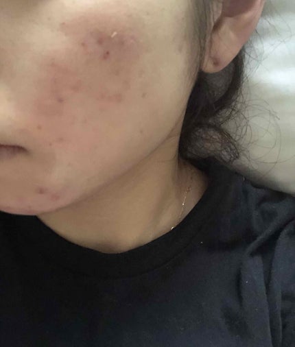 エピデュオゲル/マルホ株式会社/その他を使ったクチコミ(3枚目)