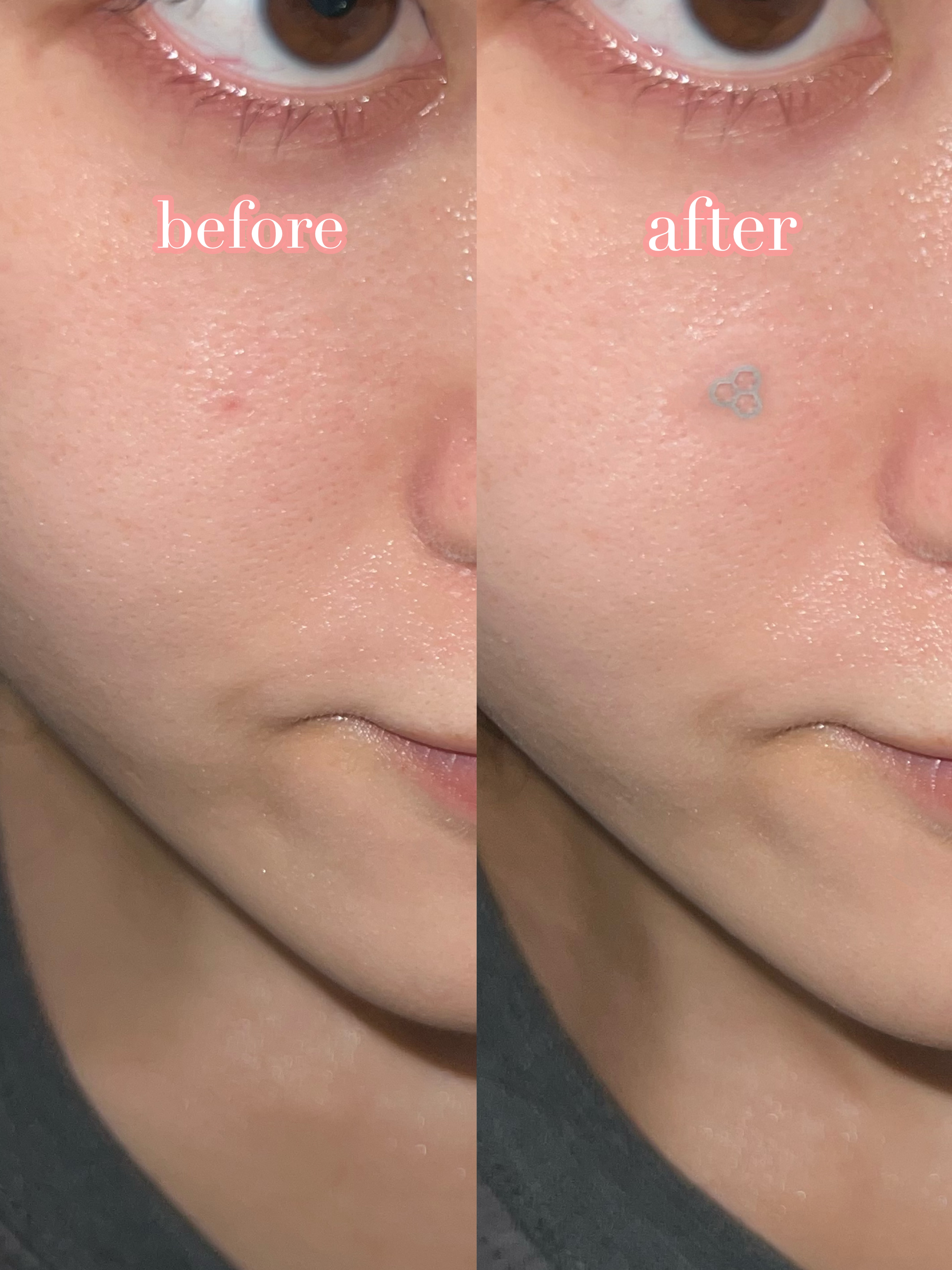 ACマグネシウムパッチ　ミニ/スノーツープラス/にきびパッチを使ったクチコミ（3枚目）