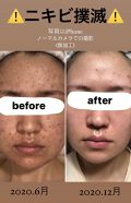 年代 肌質別 Acアクティブ フェイスローション モイスト Novの口コミ 57件 Lips