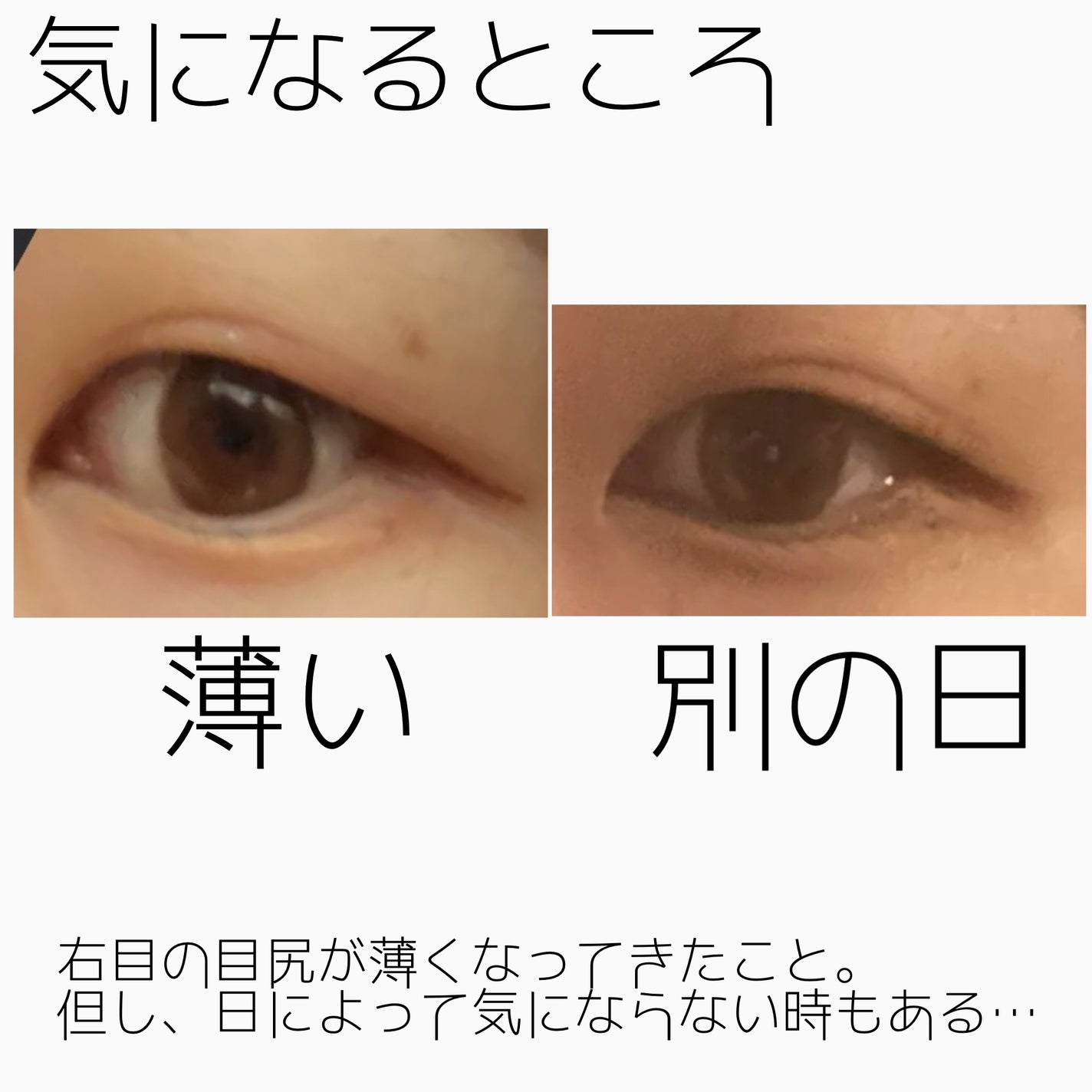 NANO@フォロバ! on LIPS 「二重整形ダウンタイム記録/抜糸してから半年が経ちました。約1ヶ..」(5枚目)