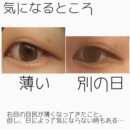 NANO@フォロバ! on LIPS 「二重整形ダウンタイム記録/抜糸してから半年が経ちました。約1ヶ..」(5枚目)