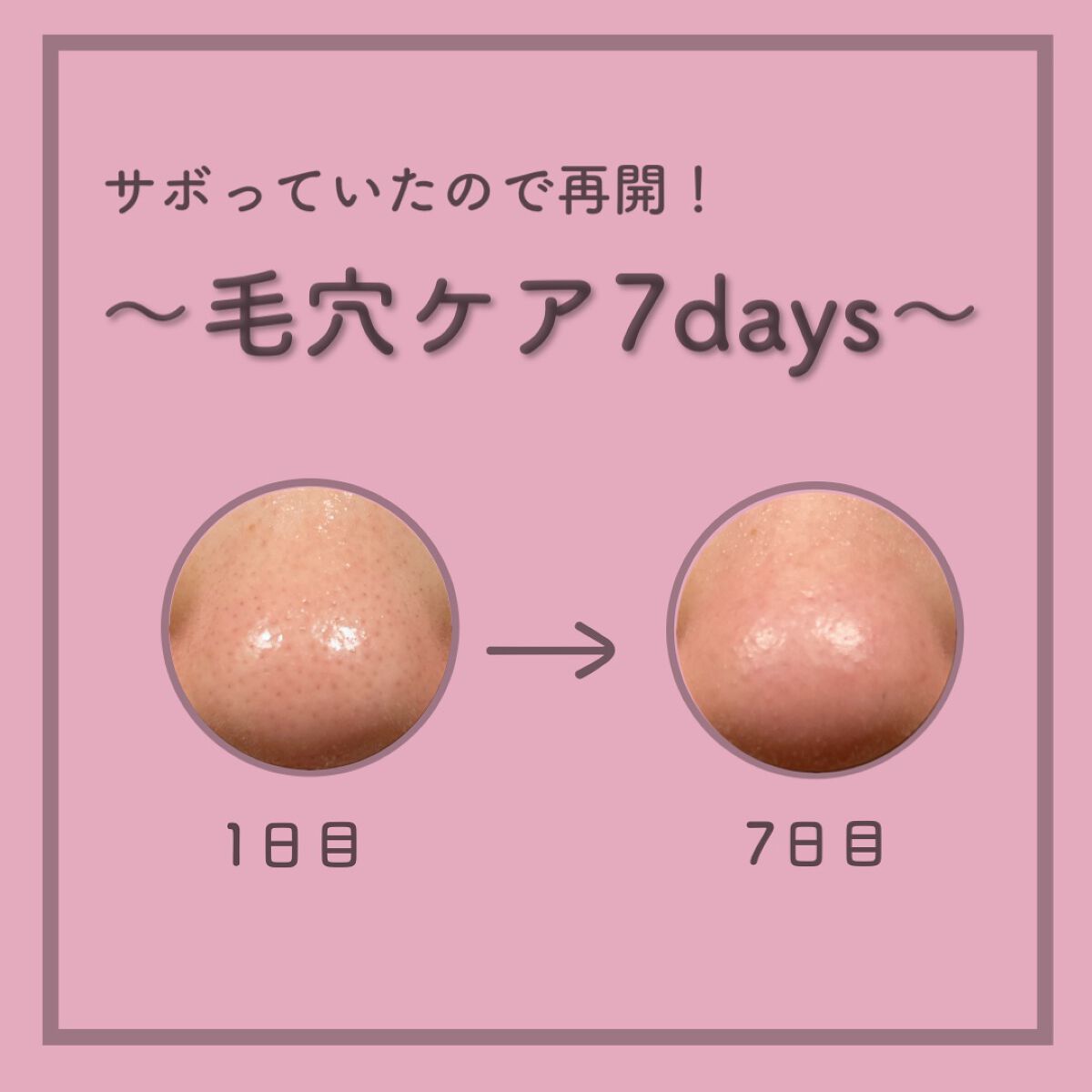 ダーマレーザースーパーVC100マスク/クオリティファースト/シートマスク・パックを使ったクチコミ（1枚目）