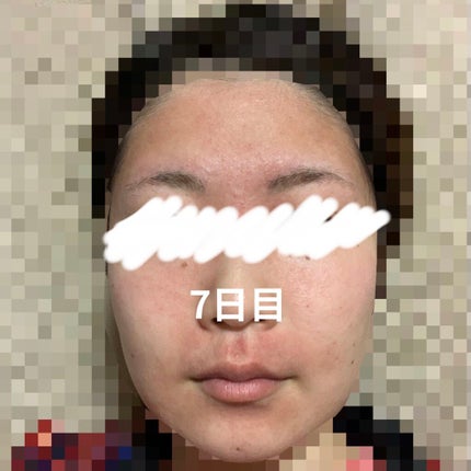 デュアック配合ゲル/ポーラファルマ/その他を使ったクチコミ(2枚目)