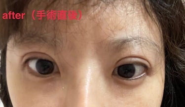 しおり on LIPS 「埋没3回目😭埋没が取れてしまったので昨日、やり直しました前は湘..」（2枚目）