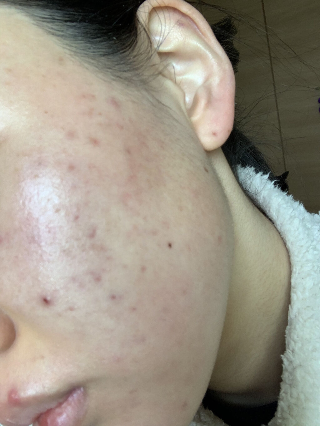 エピデュオゲル/マルホ株式会社/その他を使ったクチコミ（2枚目）