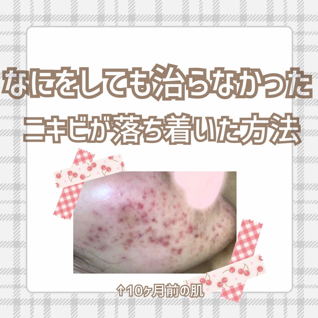 ノブ A アクネソープ/NOV/洗顔石鹸を使ったクチコミ(1枚目)